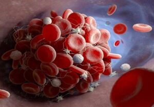 چگونه سرطان باعث مرگ میشود؟ نظریه جدید لخته شدن خون