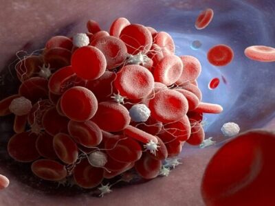 چگونه سرطان باعث مرگ میشود؟ نظریه جدید لخته شدن خون