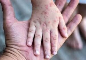 گزارش جدید سازمان جهانی بهداشت؛ شیوع مجدد سرخک و تهدیدهای جدید