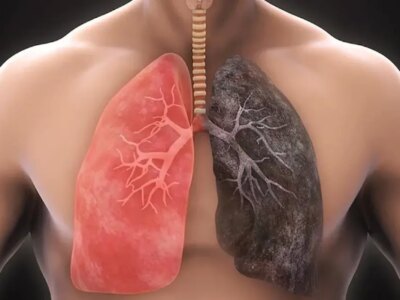 آیا ریه سیگاریها پس از ترک دوباره سالم میشود؟