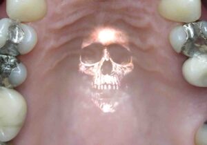 آیا آمالگام سمی است؟