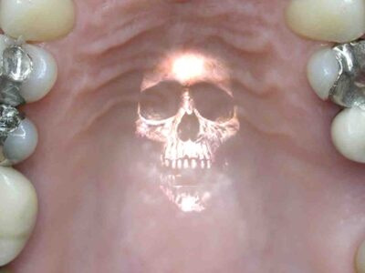 آیا آمالگام سمی است؟