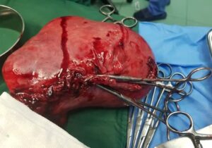 جراحی موفقیت‌آمیز برداشتن توده ۲ کیلویی در قم