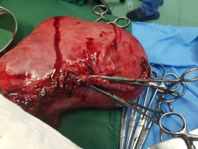 جراحی موفقیت‌آمیز برداشتن توده ۲ کیلویی در قم