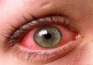 عوارض آلودگی هوا بر چشم