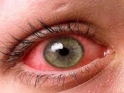 عوارض آلودگی هوا بر چشم