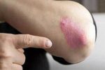 کاهش ۳۰ درصدی خطر پسوریازیس با یک عادت ساده در سبک زندگی