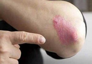 کاهش ۳۰ درصدی خطر پسوریازیس با یک عادت ساده در سبک زندگی