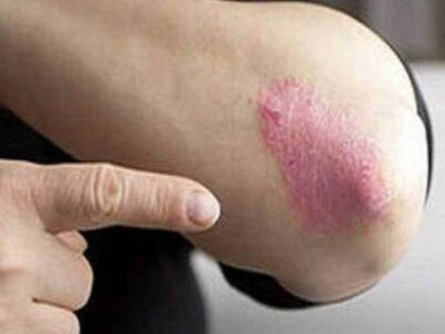 کاهش ۳۰ درصدی خطر پسوریازیس با یک عادت ساده در سبک زندگی