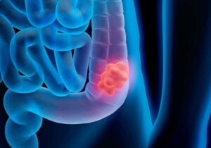 هشدار در مورد ابتلا به بیماری خاموش سرطان روده بزرگ
