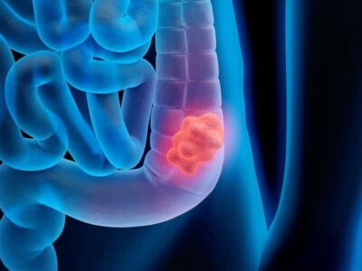 هشدار در مورد ابتلا به بیماری خاموش سرطان روده بزرگ