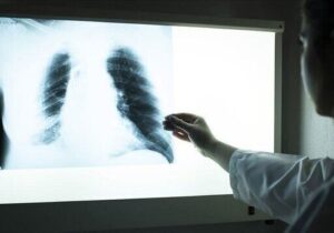 آلودگی هوا و دخانیات؛ دو عامل اصلی تهدیدکننده سلامت ریهها