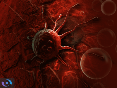 انقلاب فناوری ایرانی در جراحی سرطان پستان؛ تشخیص ۱۵ ثانیهای با دقت ۹۰ درصد