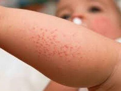 احتمال ابتلای نوزادن به این عوارض پوستی وجود دارد