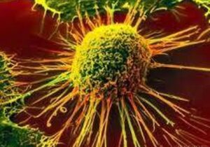 مراجعه دیرهنگام، چالش جدی درمان سرطان پستان در ایران