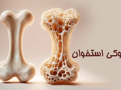 درباره پوکی استخوان چه می دانید؟