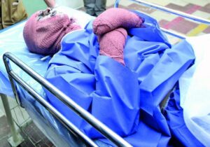 درخواست از رئیس جمهور؛ اول دی روز پیشگیری از سوختگی نامیده شود