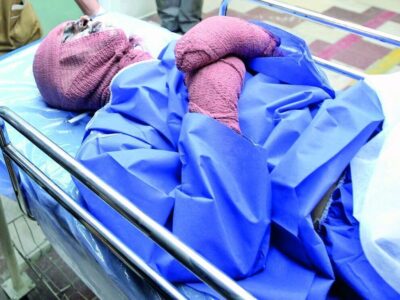 درخواست از رئیس جمهور؛ اول دی روز پیشگیری از سوختگی نامیده شود