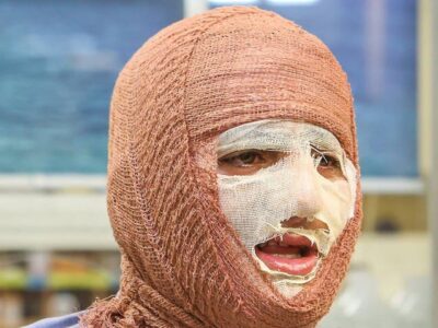 منطقه کاشان بیمارستان تخصصی سوختگی ندارد