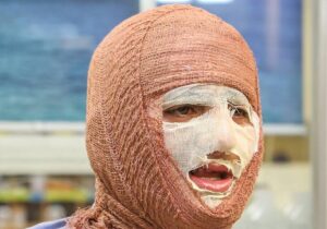 جلالی: سالانه حدود ۳۰۰ هزار نفر به مراکز سوختگی کشور مراجعه میکنند