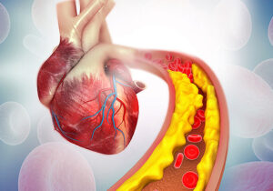 کاهش کلسترول، بدون نیاز به دارو/ چربی‌های کاهنده کلسترول کدامند؟/ این ورزش‌ها موثرند