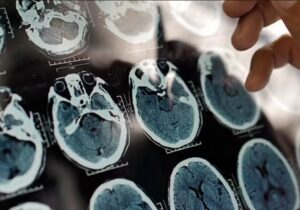 یک عامل مهم و کمتر گفته شده درباره روند پیشرفت آلزایمر