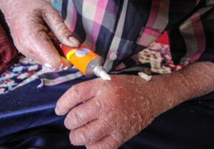 ماجرای رها شدن یک نوزاد پروانهای در بیمارستان