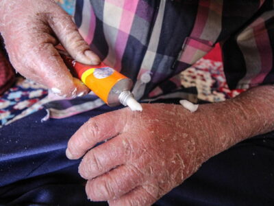 ماجرای رها شدن یک نوزاد پروانهای در بیمارستان