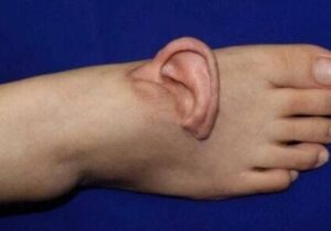 نجات لاله گوش زن چینی با پیوند موقت روی پا