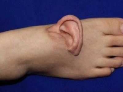 نجات لاله گوش زن چینی با پیوند موقت روی پا