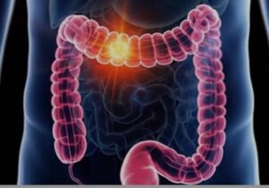 علائم گوارشی را ساده نگیرید/ هر خون‌ریزی هموروئید نیست