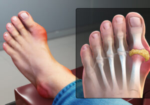 آیا نقرس بیماری پولدارهاست؟