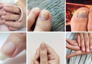 ۷ علامت هشداردهنده کلسترول بالا در ناخن