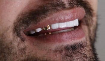 آیا نماز با دندان طلا برای مردان صحیح است؟