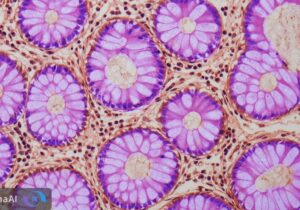 هشدار پنهان در روده؛ تغییرات ژنتیکی خطر سرطان روده بزرگ را بالا می‌برد!