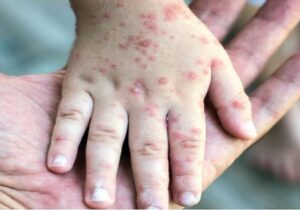 ثبت ۷۱۴ مورد «سرخک» در کشور؛ اوج ابتلا در اردیبهشت