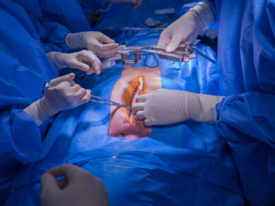 پیوند موفق قلب به دختر ۱۸ ساله در مشهد